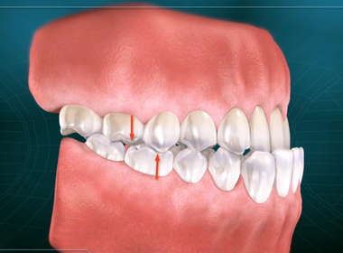 MALOCCLUSION (CLASS II)