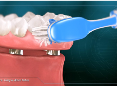 CARING FOR A HYBRID DENTURE