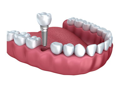 DENTAL IMPLANTS