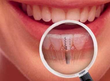 BONDED FILLINGS