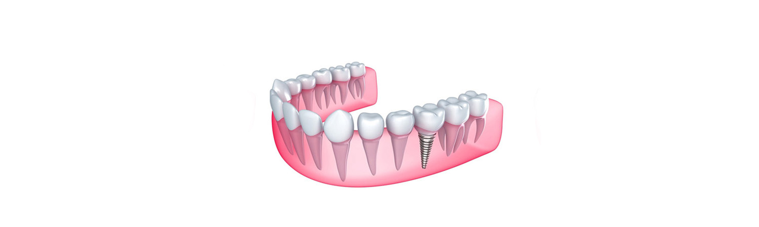 implant-restoration